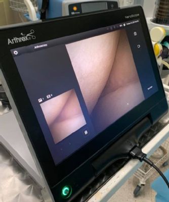 Výnimočný zákrok ortopédov Nemocnice AGEL Košice-Šaca: Nanoskopia kolena s najmenšou optikou
