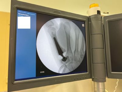 Výnimočná operácia umelej kĺbovej náhrady palca ruky v šačianskej nemocnici. Obnovuje pôvodný pohyb aj kĺb